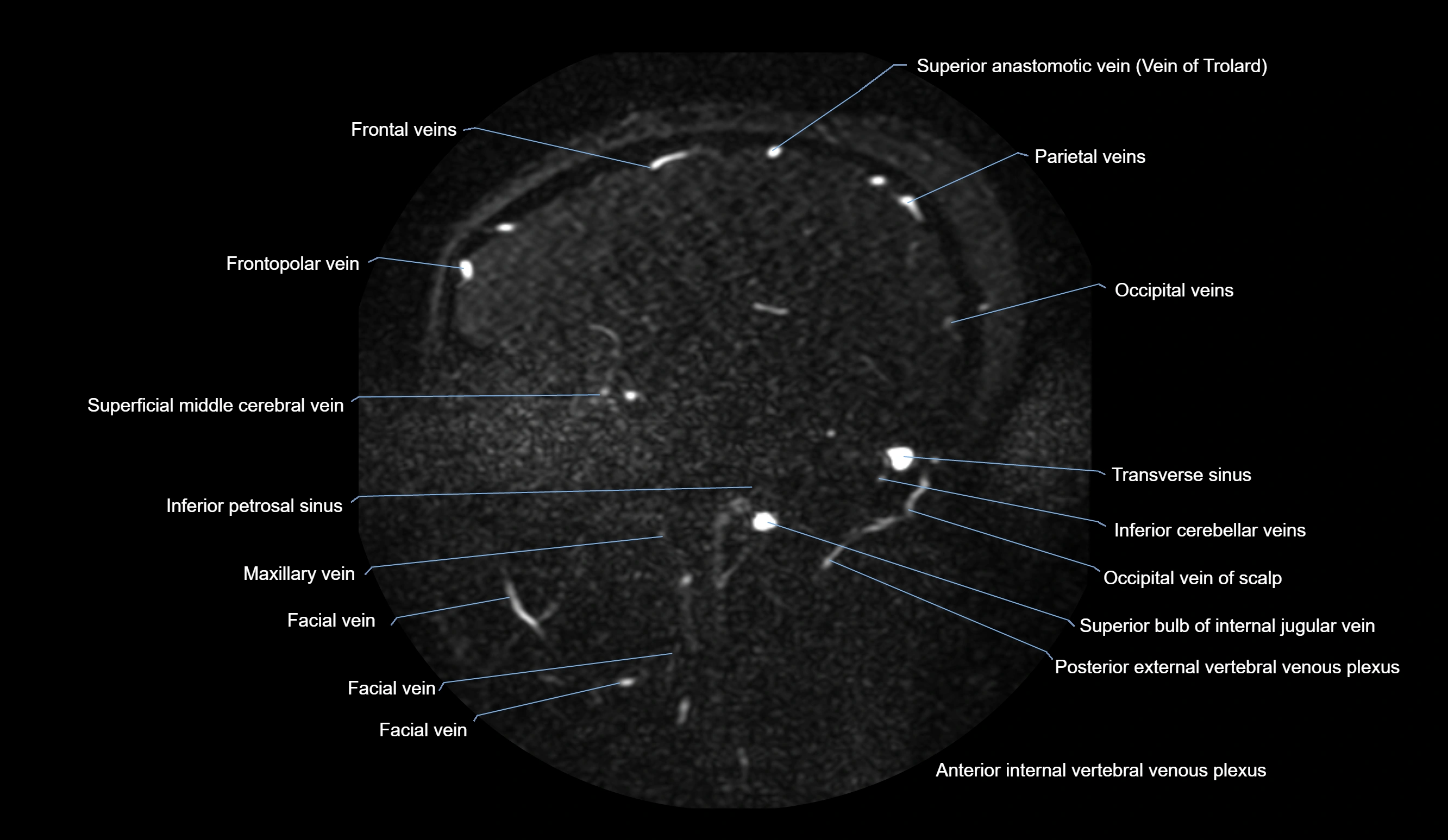MRV brain sagittal anatomy 3T MRI images -img-01015-00060.webp